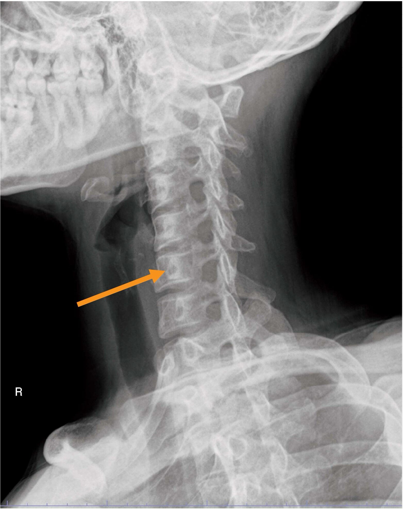 頸椎のX線写真(別冊No.9)