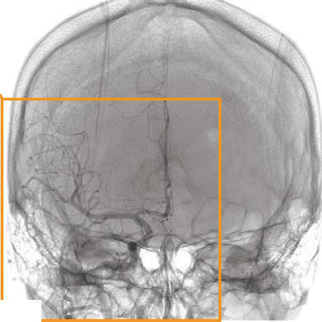 頭部の血管造影写真(別冊No.10)