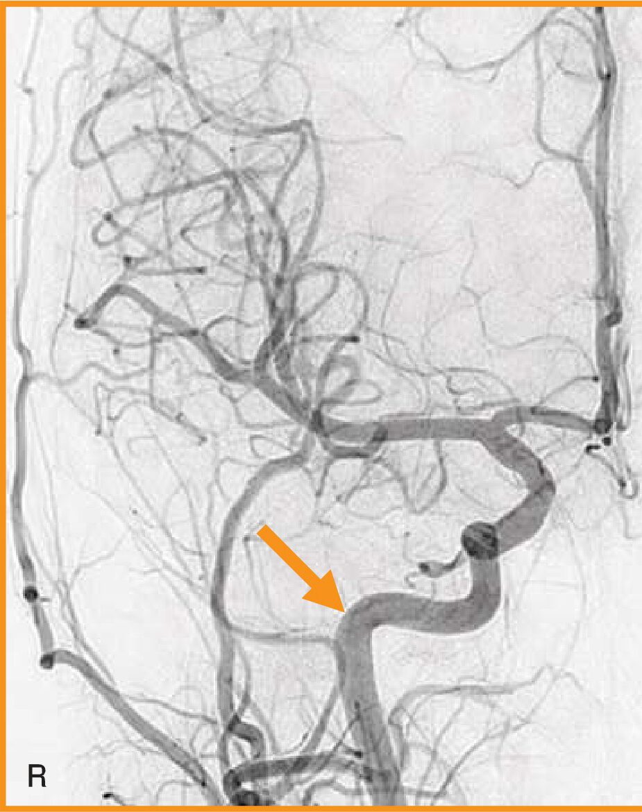 頸部の造影CT像(別冊No.11)