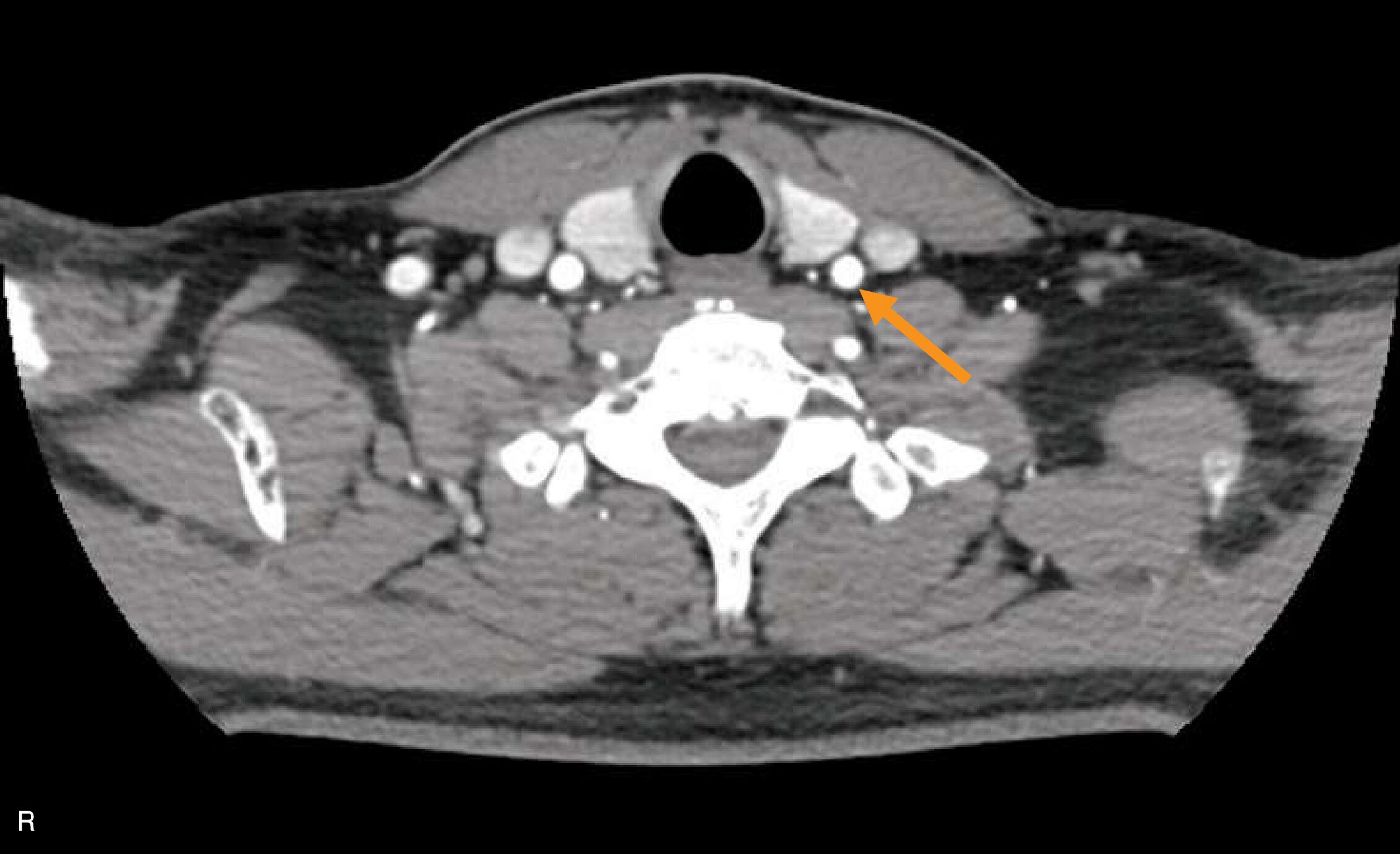 頸部の造影CT像(別冊No.11)