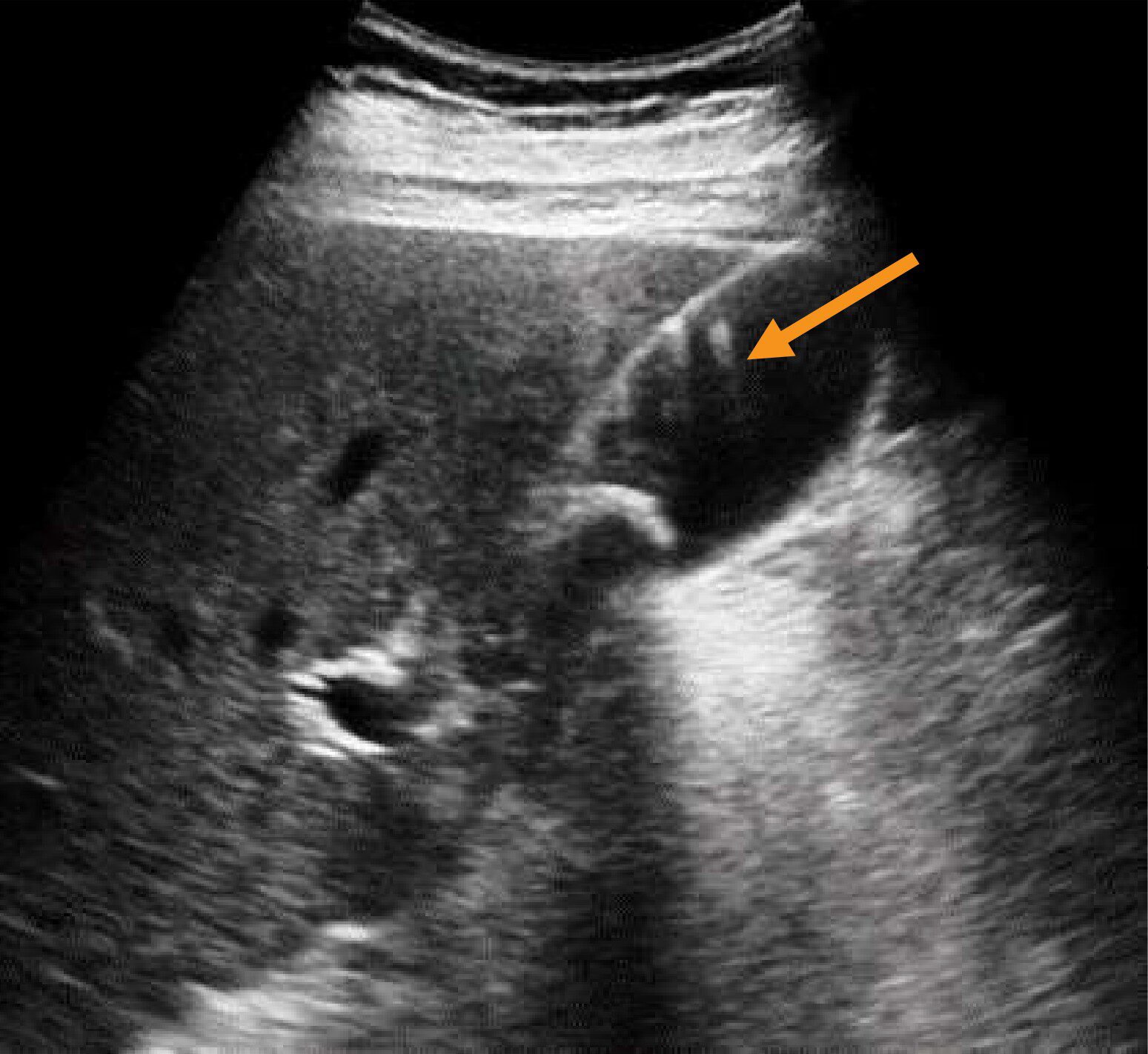 右季肋部縦走査の超音波像(別冊No.2)