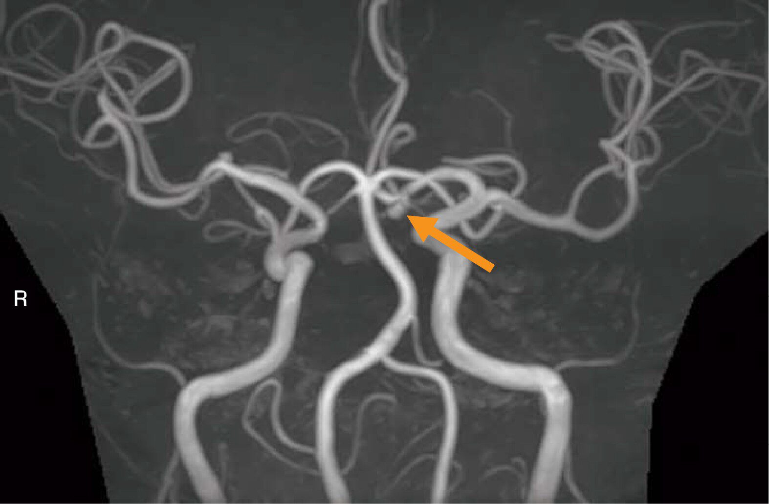 頭部MRAのMIP像(別冊No.3A)