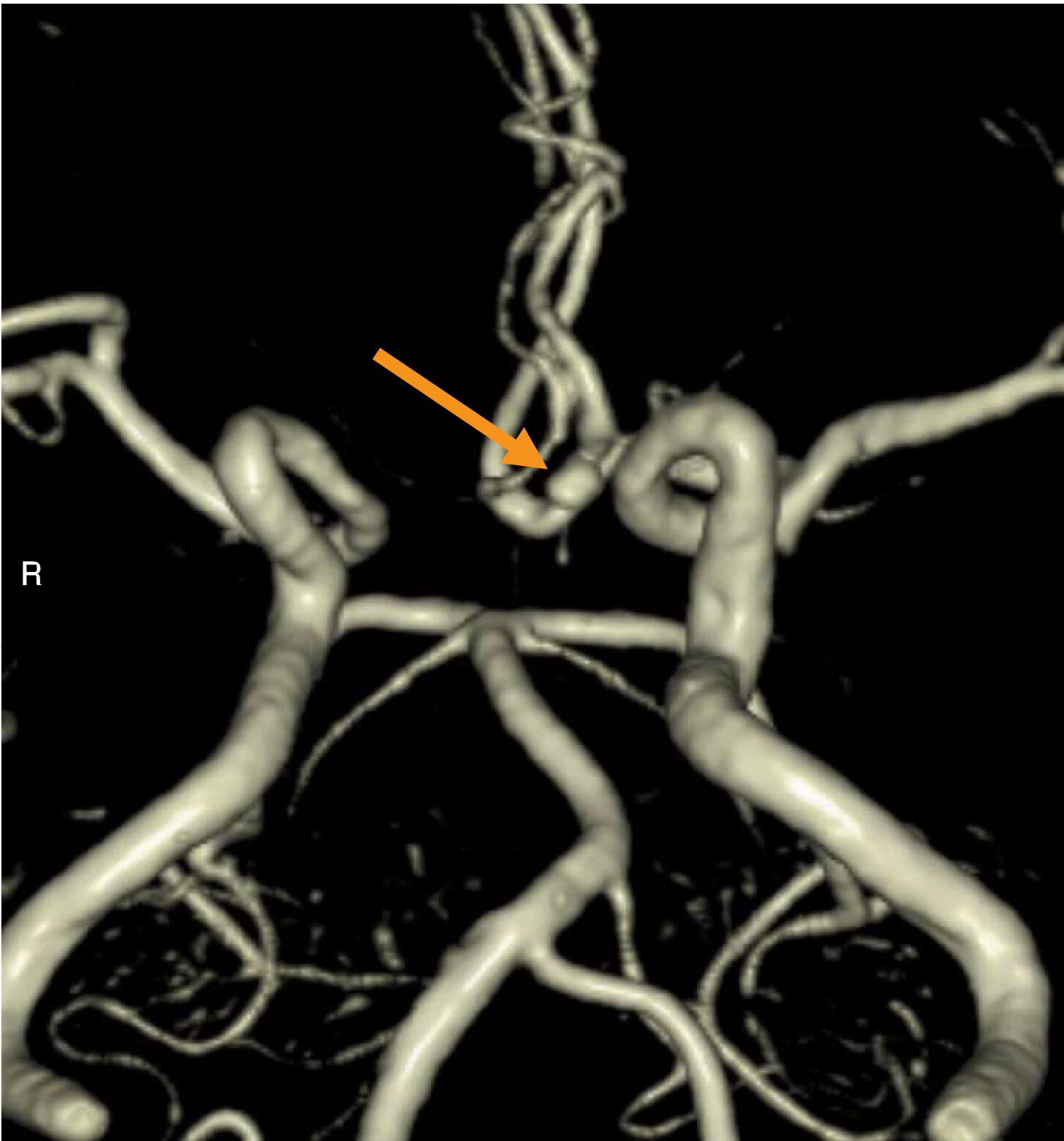 頭部MRAの3D再構成像(別冊No.3B)