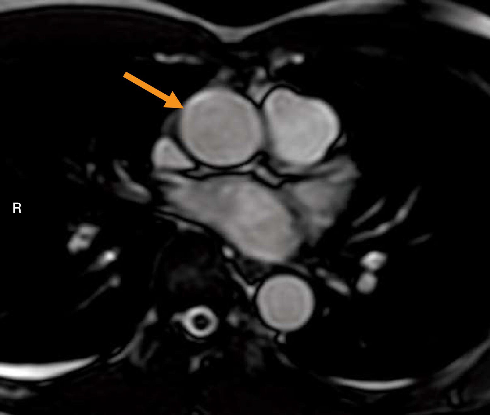 胸部MR像(別冊No.4)