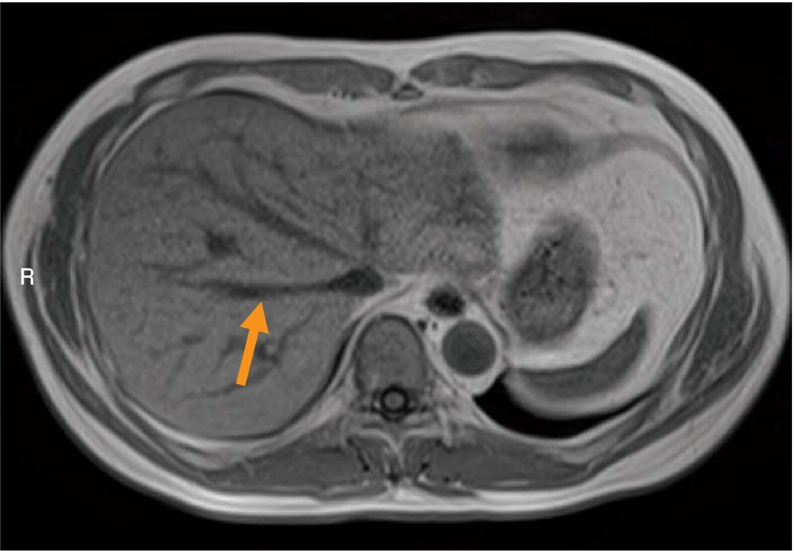 腹部MRIのT1強調像(別冊No.5)
