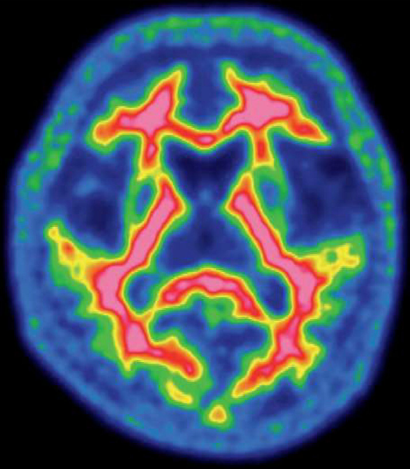 正常の脳核医学画像(別冊No.6)