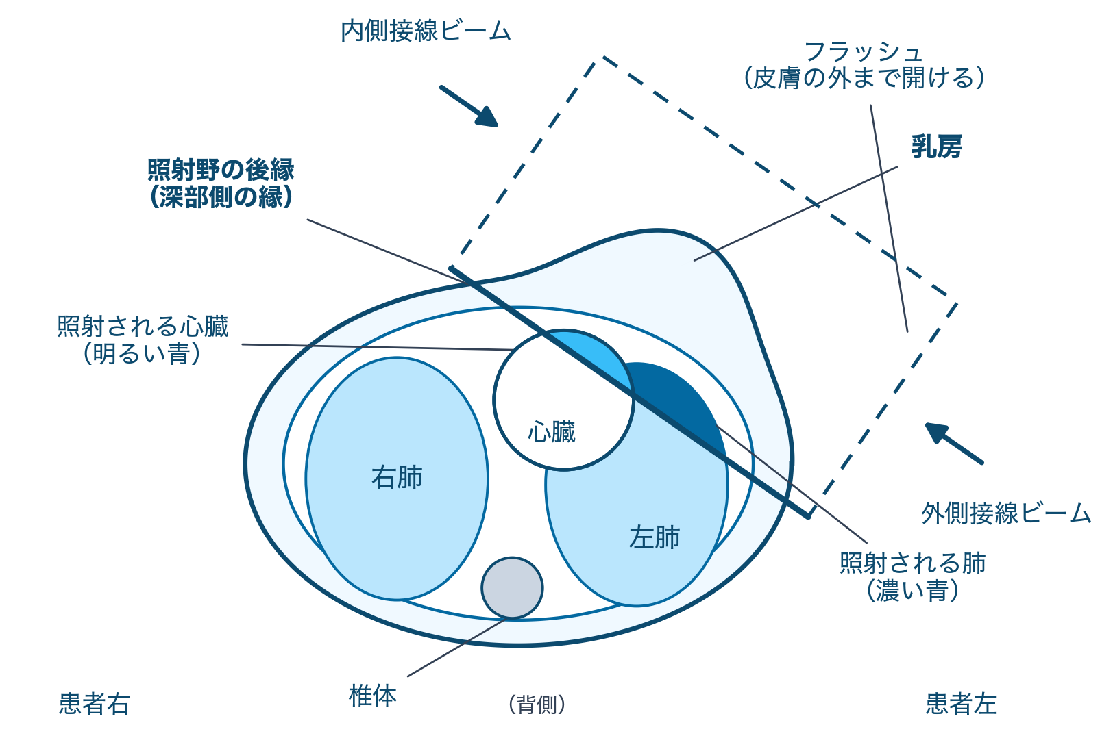 接線照射の横断面の模式図。照射野の後縁より前方に入った肺と心臓が照射される